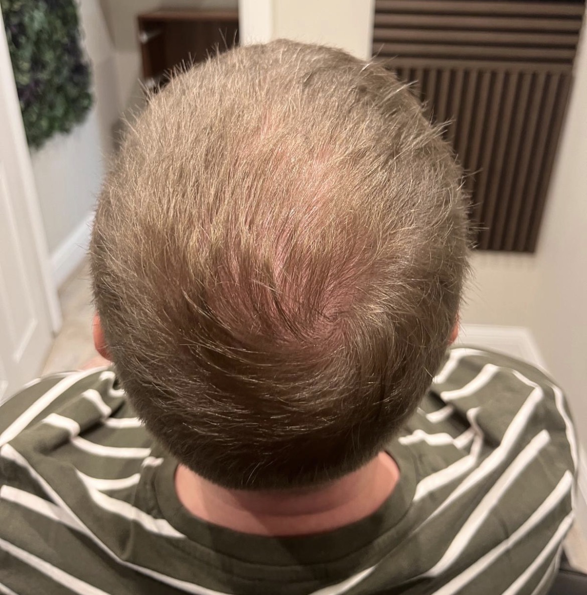 Client scalp after two PRP sessions with Abbey