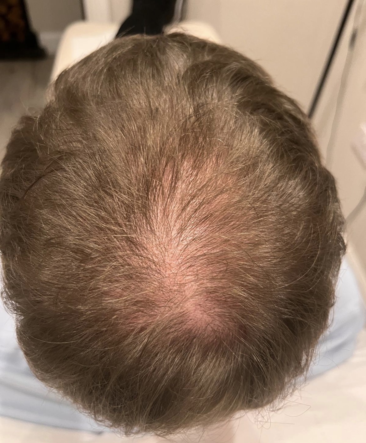 Client scalp before PRP treatment